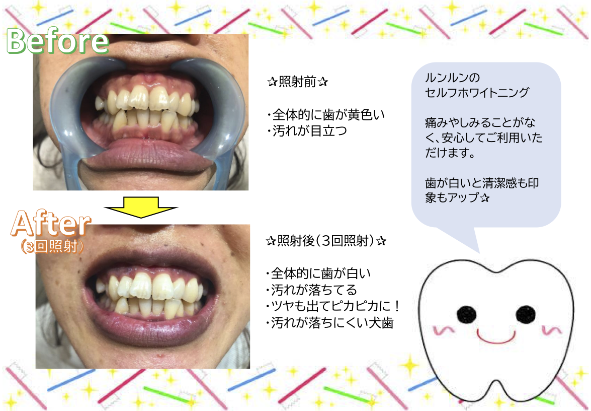 セルフホワイトニング ルンルン トータルビューティーステーション